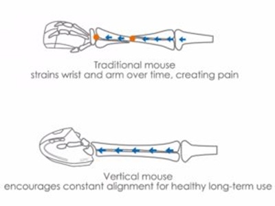 موس های ارگونومیک و پیشگیری از سندرم تونل کارپال